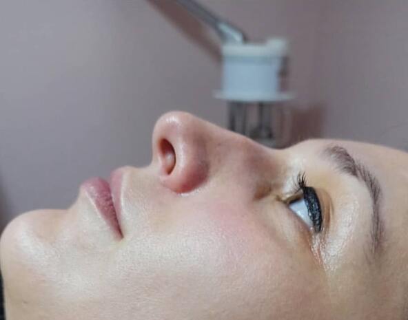 Micro Needling - Après